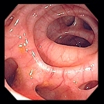  Diverticulose et anti inflammatoires