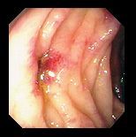  Diverticulose et anti inflammatoires