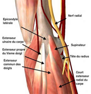 épicondylite du coude