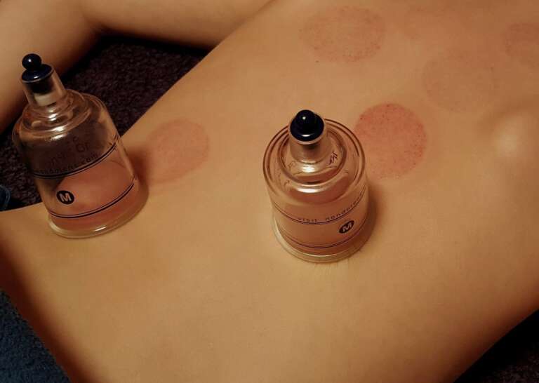 cupping-Ventouses et sport de haut niveau