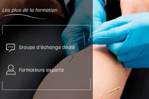 Dry Needling et Syndromes Canalaires