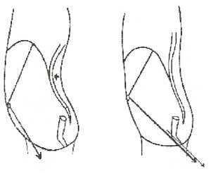 augmentation de la pression sur le périnée antérieur en position verticale