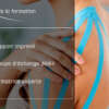 K-Taping en sénologie et pour cancer du sein